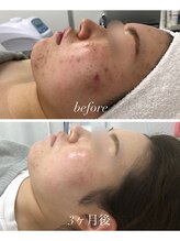 シーラックス(Sealax)/ニキビケアにも◎