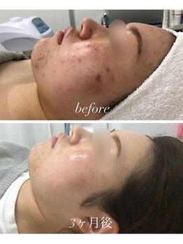 シーラックス(Sealax)/ニキビケアにも◎