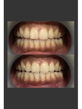 サロン ド ルナ(Salon de Luna)/セルフホワイトニング1回の効果