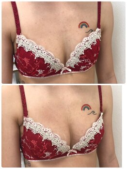 アンドモア(&more)/バストアップ症例