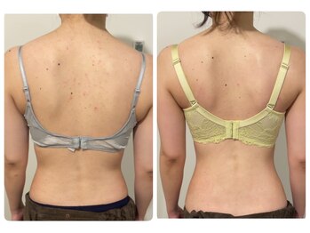 モナンジュ(ramonange)/背中のbefore after