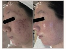 ミューベル(MYubelle)/赤みニキビケア　水光ピーリング