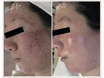 ミューベル(MYubelle)/赤みニキビケア 水光ピーリング