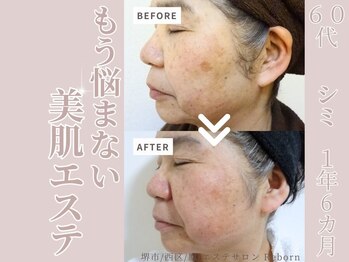 リボーン(Reborn)/６０代　シミケア(1年6ヶ月)