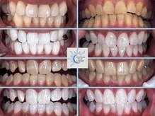 ラフ(LAUGH)/【審・美・白】 ホワイトニング