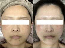 エミルカ 仙台(EMILUCA)/つや玉リフトフェイシャル