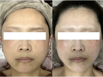 エミルカ 仙台(EMILUCA)/つや玉リフトフェイシャル