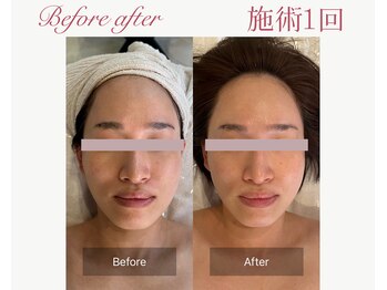 パルタージュ 三宮(Partage)/透明感あふれる肌へ