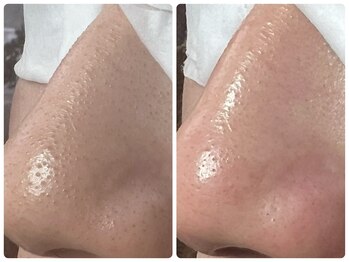 カピリナ(ka pilina)/触って実感！つるん肌へ