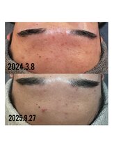 ビーマジック(Be Magic)/1回の黒ずみ撃退！