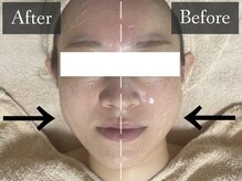 ベルフィーヌ 恵比寿店(BELFINE)/エラ張りが気になる方も必見