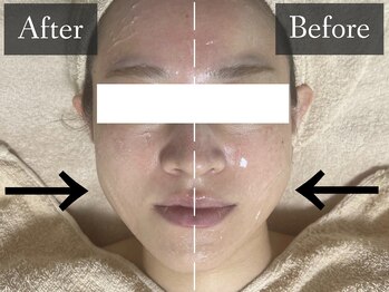 ベルフィーヌ 恵比寿店(BELFINE)/エラ張りが気になる方も必見