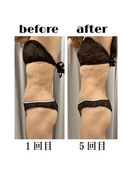 インディバケアプラチナム 横浜店/インディバ施術