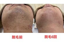 ビビ/ヒゲ脱毛/メンズ脱毛/髭脱毛