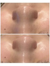 レイ(Lei)/毛穴/ハーブピーリング/本厚木