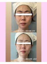 ソラ 高宮店(SORA)/小顔コルギ90分とレモンボトル