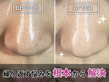 ピネ(pine)の雰囲気(未来のお肌の事を考えダメージを最小限に!赤みを極力抑えた技術)
