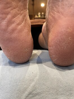 ラウレア(Laule'a)/フット角質ケア