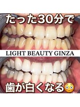 ライトビューティー 銀座店(LightBeauty)/東銀座　ホワイトニング症例写真