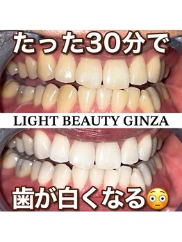 ライトビューティー 銀座店(LightBeauty)/東銀座　ホワイトニング症例写真