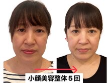 ナチュラルセラピー ドロップ(Drop)/４０代歪み、面長、二重あご改善