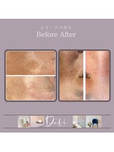 デフィ(Defi)/シミ/ビフォーアフター