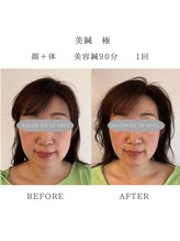 ルソール(Le seul)/鍼灸/美容鍼/累計20,000人超え