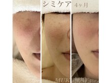 ムク(MUKU 無垢)/シミケア