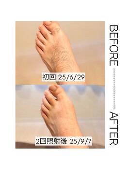 フィズ 新宿店(FIS)/部分脱毛☆脱毛途中経過☆