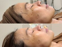 ブラン(BLANC)/【光フェイシャル】フォトRF