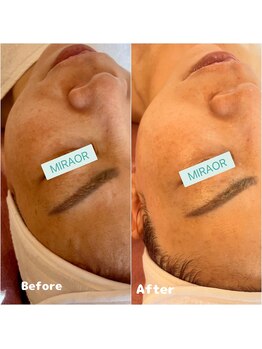 ミラー(MIRAOR)/アンストレス乳酸ピーリング水光