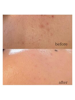 アノネ(Anone.)/サイエンス美容プラズマND EX