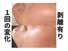 モニ 福岡(Moni)/ハーブピーリング で ニキビケア