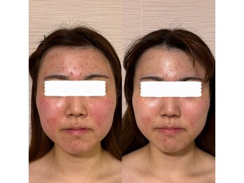 エクレクティック(ECLECTIC)/肌質改善/ハーブピーリング