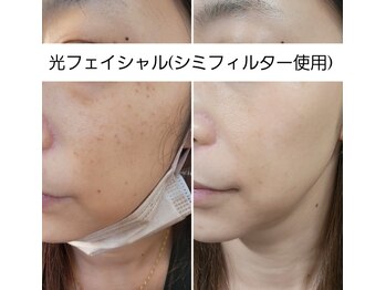 サロン ベル(Salon B'elle)/光フェイシャル(シミフィルター)