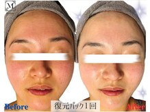 マリス(MARISS)/復元パック1回<毛穴/小顔/美白>