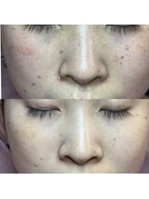 エミュ(emu)/最新シミケア