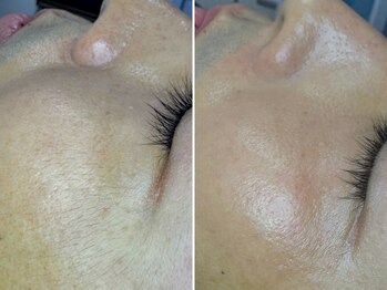 男眉salon OnFleek!渋谷店 【メンズ眉毛サロン・メンズアイブロウサロン】の写真/今話題の【フェイシャルワックス脱毛】取扱店★まずはお肌の土台作りから!フェイシャルワックス7000円~