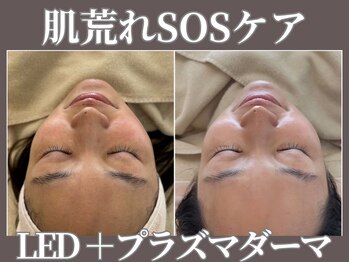 マヴィ 今福鶴見店(MavY.)/肌荒れSOS
