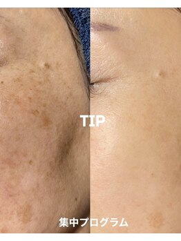 サロンサイ(salonsai)の写真/ほうれい線・たるみには、真皮層へのアプローチが改善の道!ふわっとツヤ肌取り戻しましょう◎