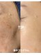 サロンサイ(salonsai)の写真/ほうれい線・たるみには、真皮層へのアプローチが改善の道!ふわっとツヤ肌取り戻しましょう◎
