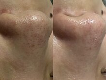 リボーン(REBORN)/毛穴洗浄