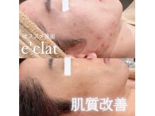 エクレ(eclat)