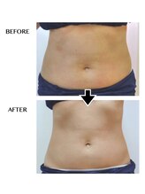 シンシア(sincere)/腹/ウエスト/腰回り/痩身エステ