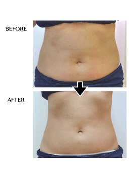 シンシア(sincere)/腹/ウエスト/腰回り/痩身エステ