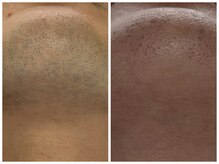 フェリス(FELIZ)/ヒゲ脱毛が楽になるヒゲ脱毛