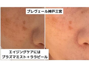 プレヴェール 神戸三宮/ララピール・プラズマミスト