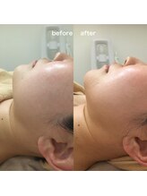 アミュレット(amulette)/インディバフェイシャル