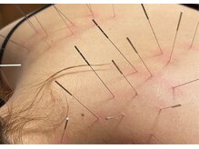 辛いお悩み笠岡で唯一のルート鍼ぜひ受けてください！