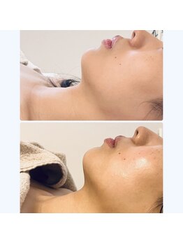 ルミア(LUMIA)/小顔造形ロイヤルコース１回目